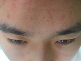 脸上长青春痘