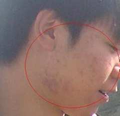 脸上长痘痘