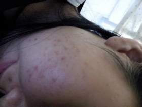 脸颊长痘