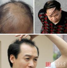 真菌脱发有哪些症状?