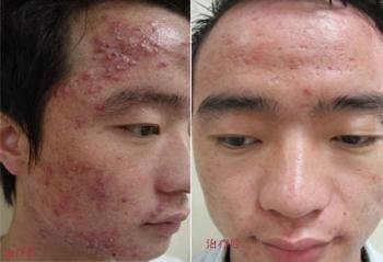 脸上长痤疮是什么引起的?