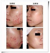 青春痘是由哪些因素感染形成的