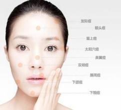 痘痘是因为那些因素导致的