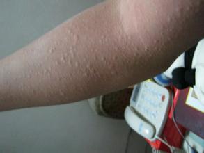 一冷就起红疙瘩或是荨麻疹