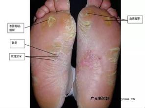怎么预防夏季手足癣的发病