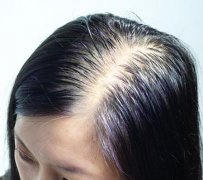 经常掉头发的原因
