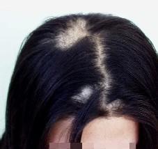 女性斑秃