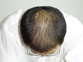 脱发问题