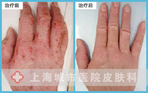 治疗前后对比图