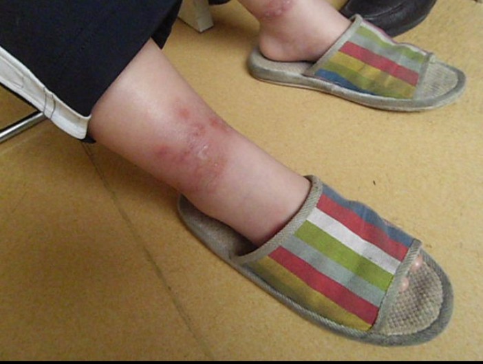 患者症状
