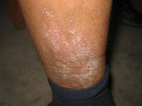 得了神经性皮炎后会有哪些病症症状?