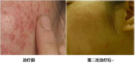苏州治疗神经性皮炎哪家医院好