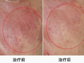 面部皮肤过敏症状的护理